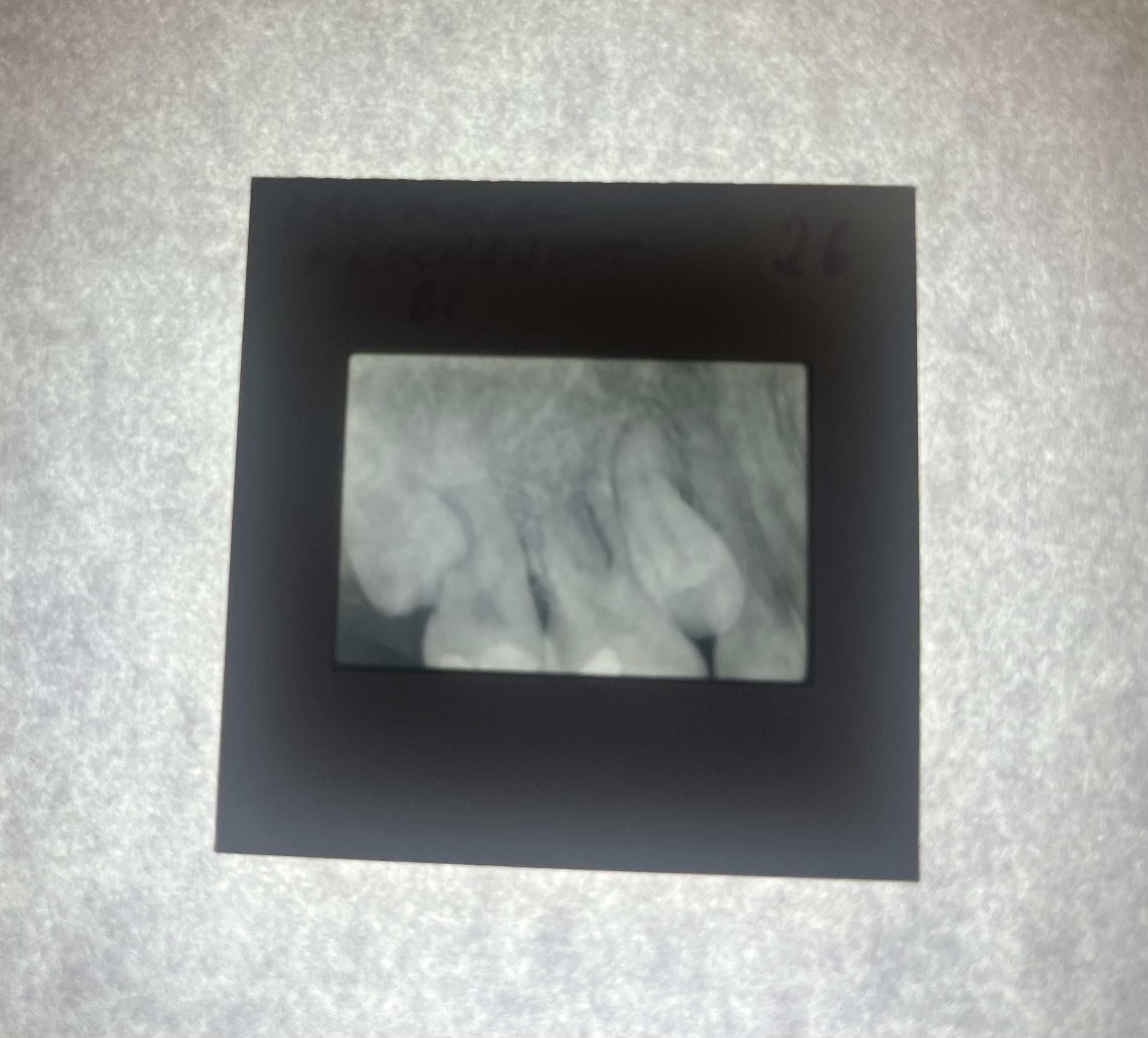Dental X-Ray (Bitewing) Slide