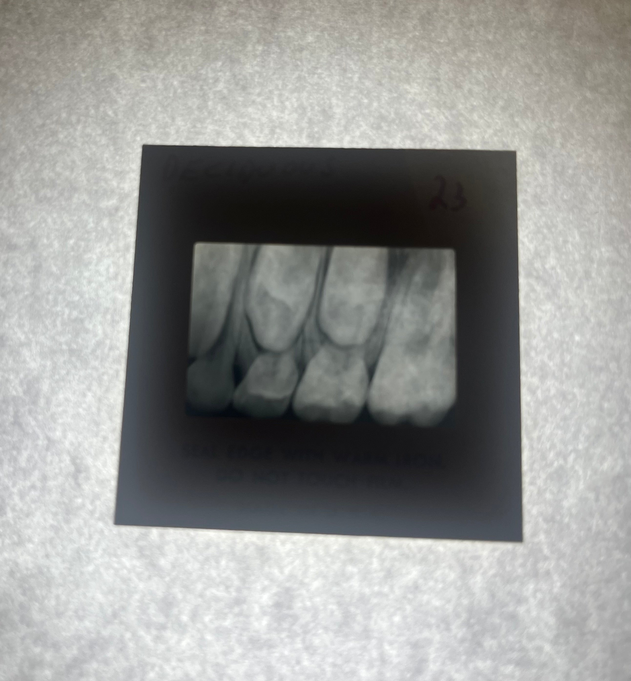 Dental X-Ray (Bitewing) Slide