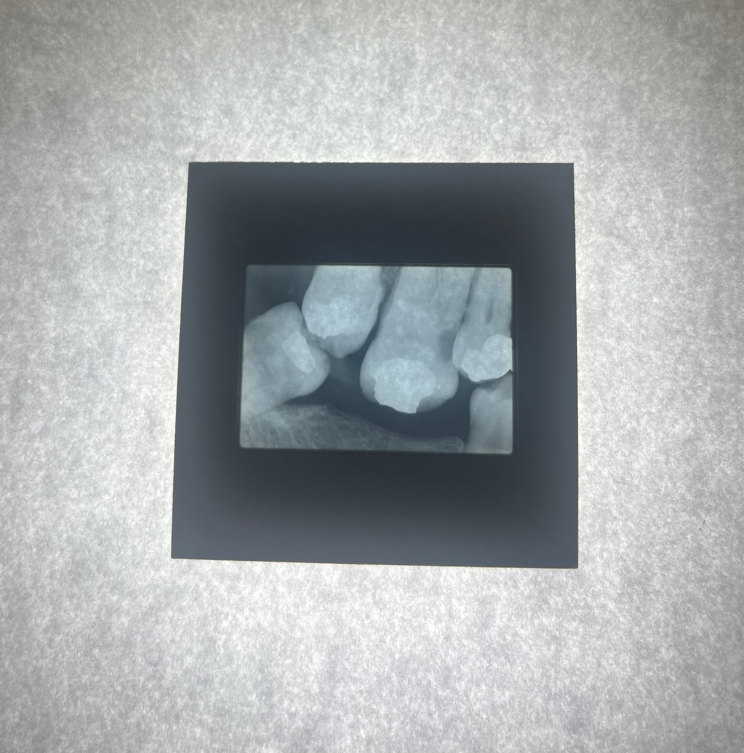 Dental X-Ray (Bitewing) Slide