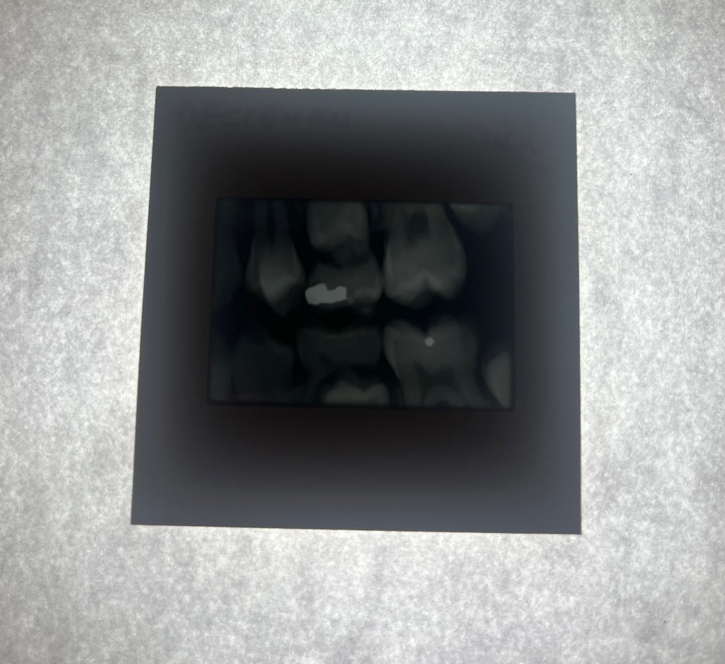 Dental X-Ray (Bitewing) Slide