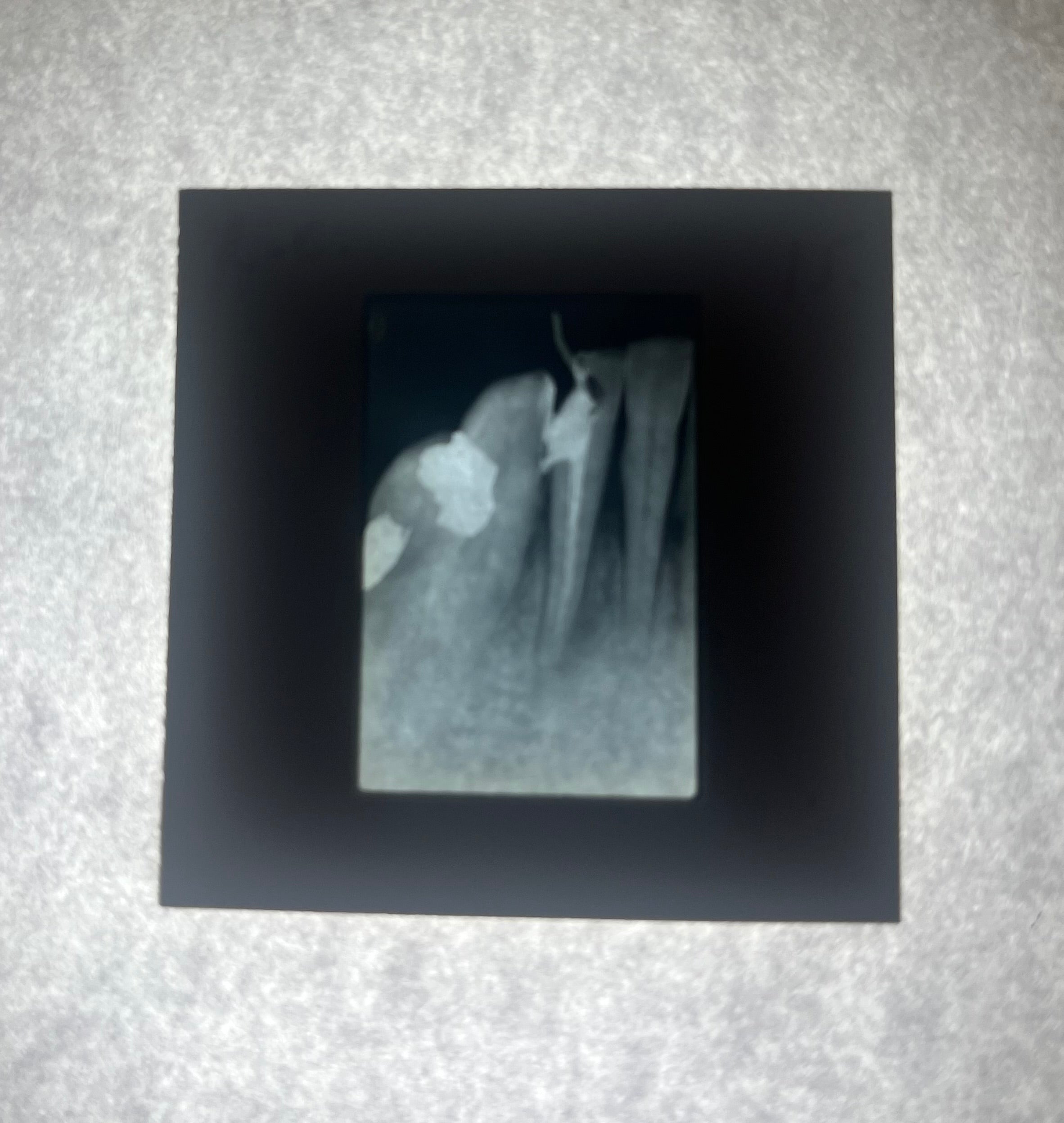 Dental X-Ray (Bitewing) Slide