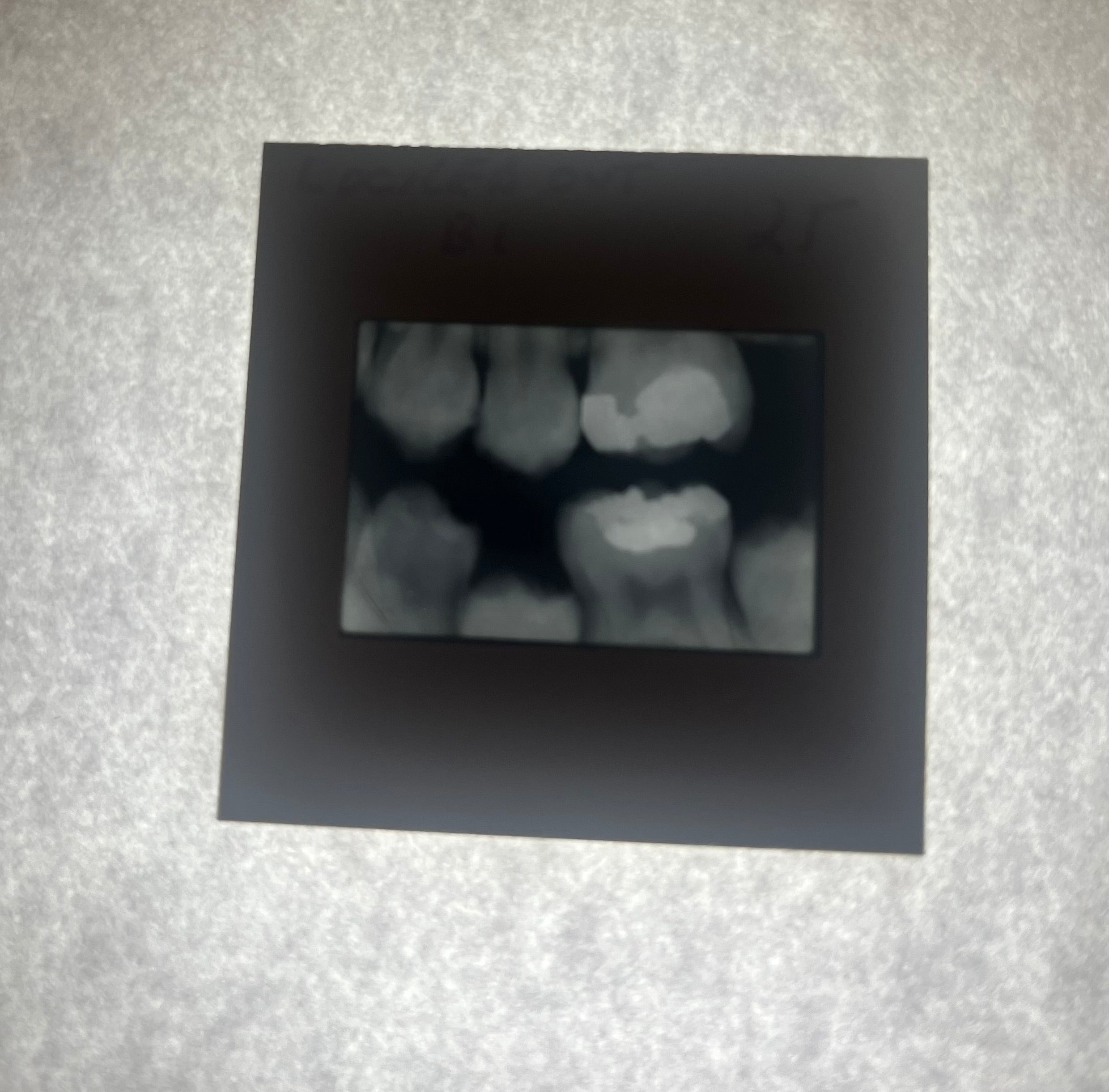 Dental X-Ray (Bitewing) Slide