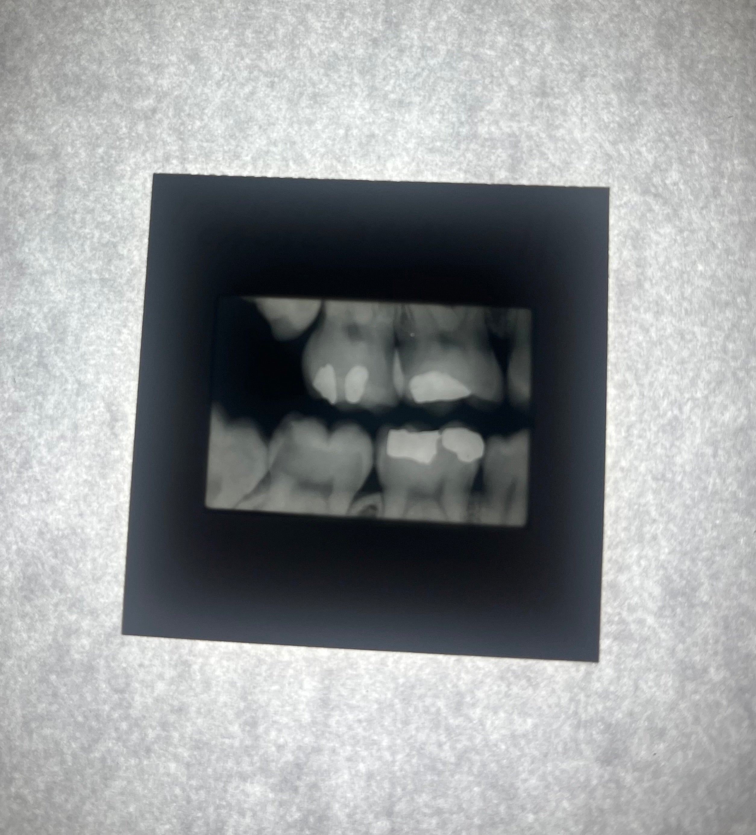 Dental X-Ray (Bitewing) Slide