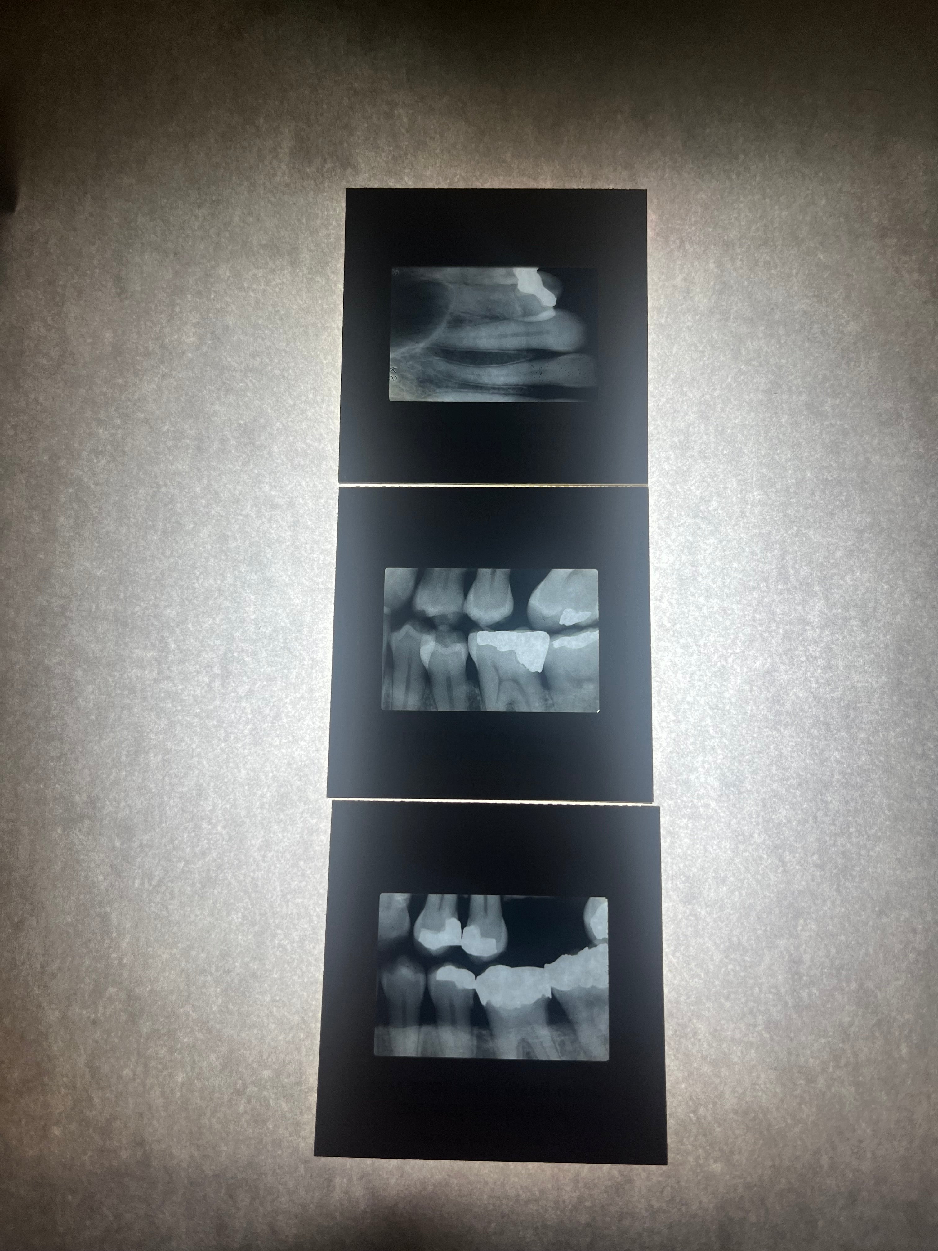 Dental X-Ray (Bitewing) Slide