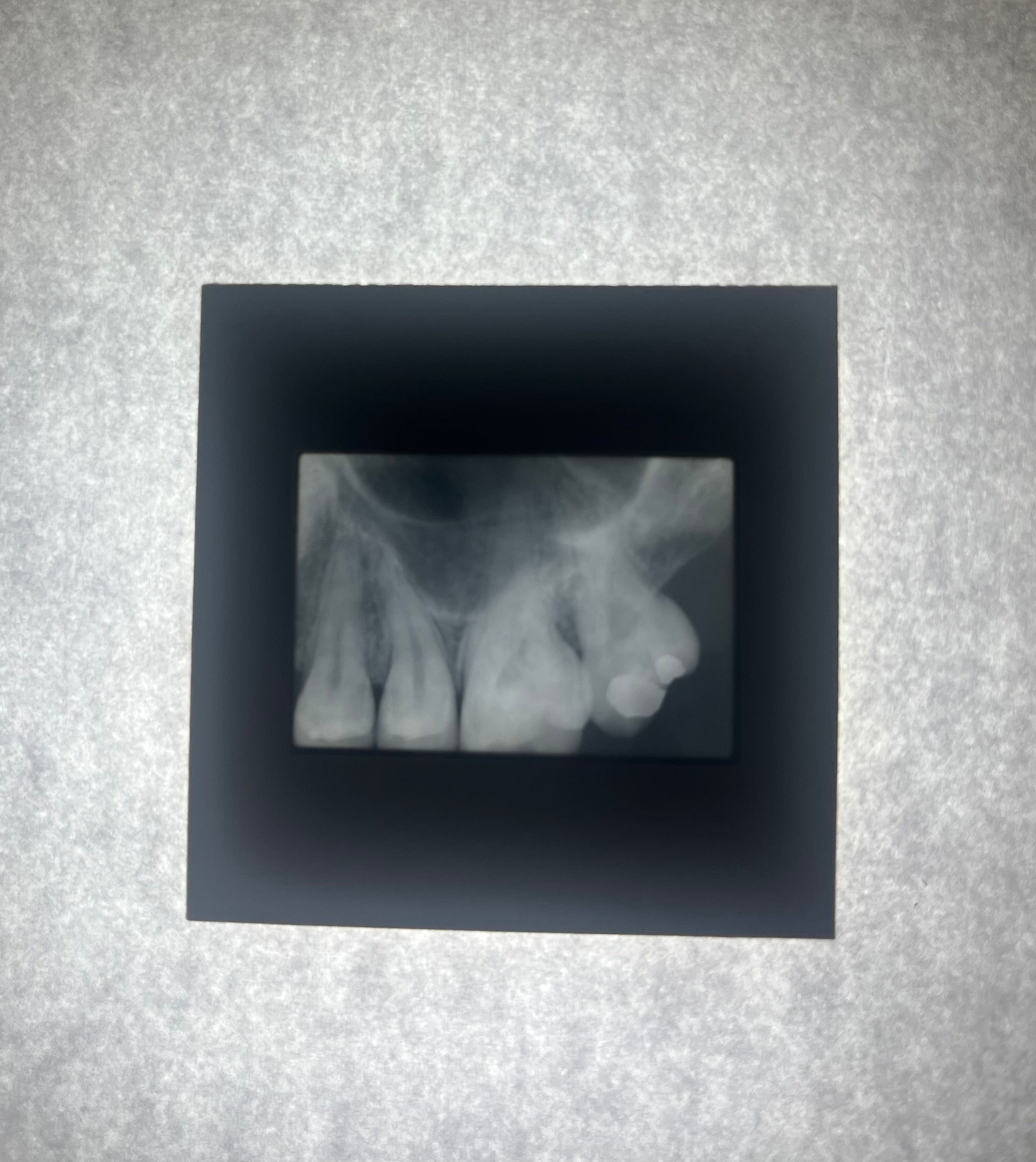 Dental X-Ray (Bitewing) Slide
