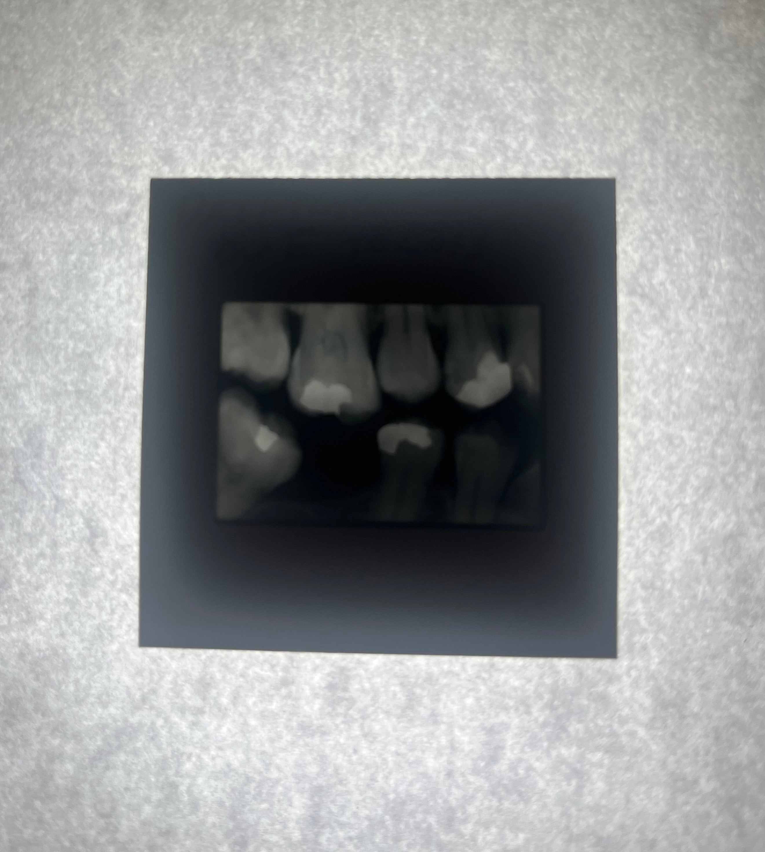 Dental X-Ray (Bitewing) Slide