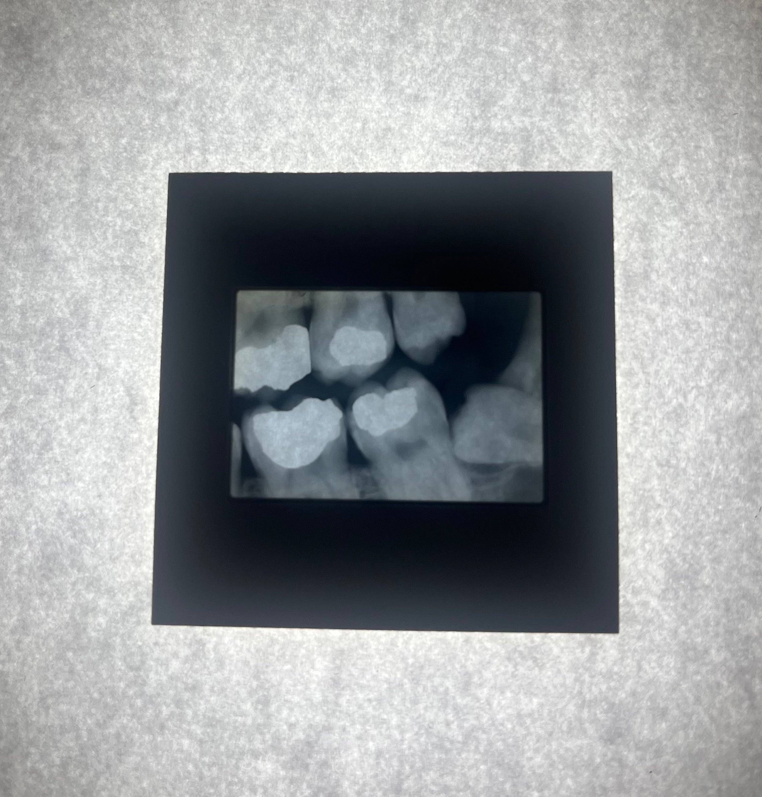 Dental X-Ray (Bitewing) Slide