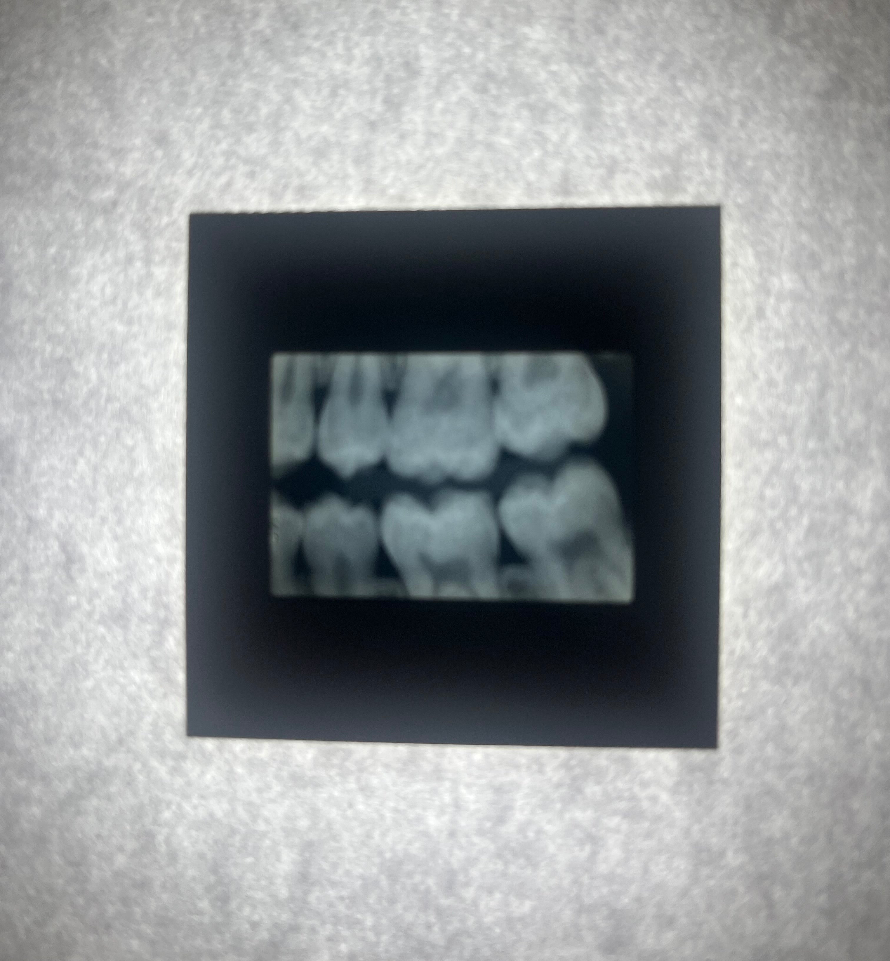 Dental X-Ray (Bitewing) Slide